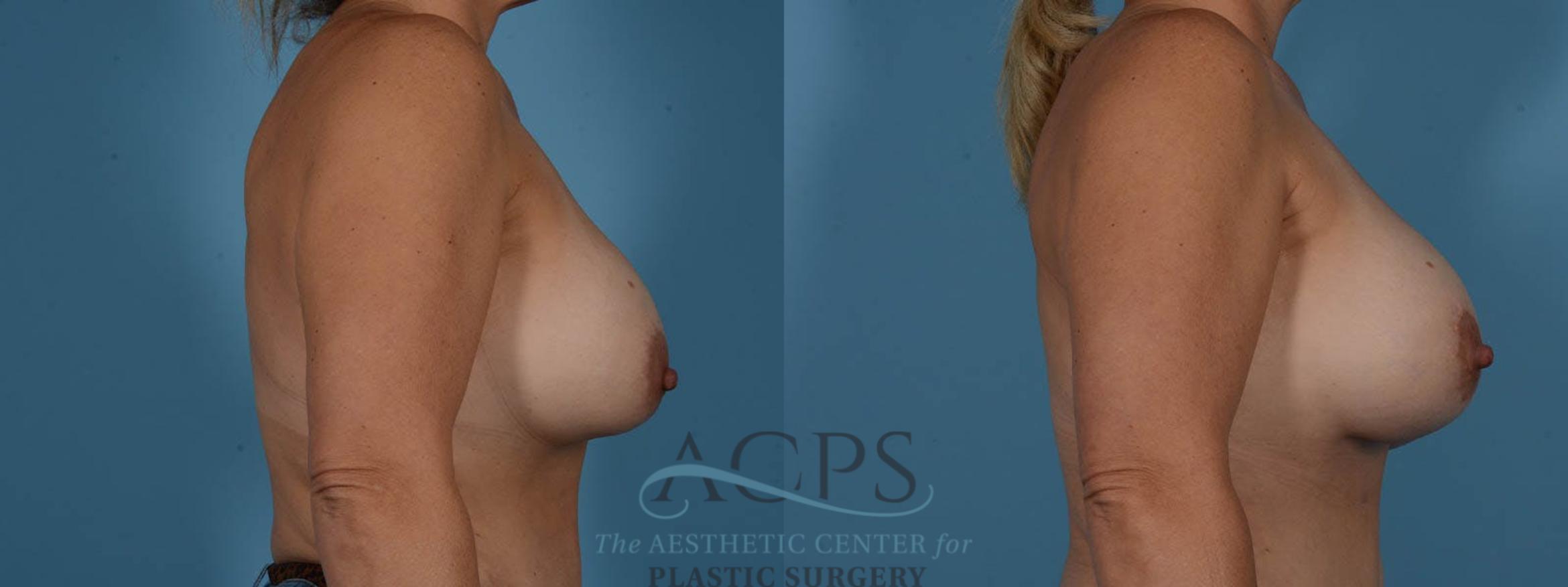 Before & After Breast Revision Case 1052 Side View: View in Houston, TX