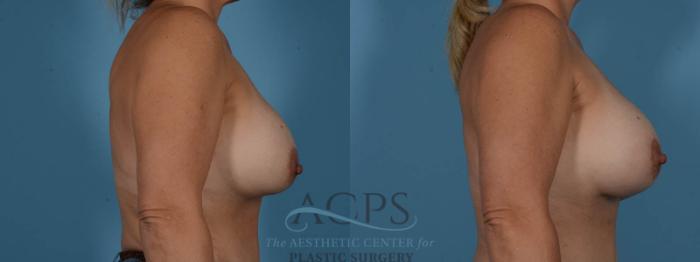Before & After Breast Revision Case 1052 Side View: View in Houston, TX