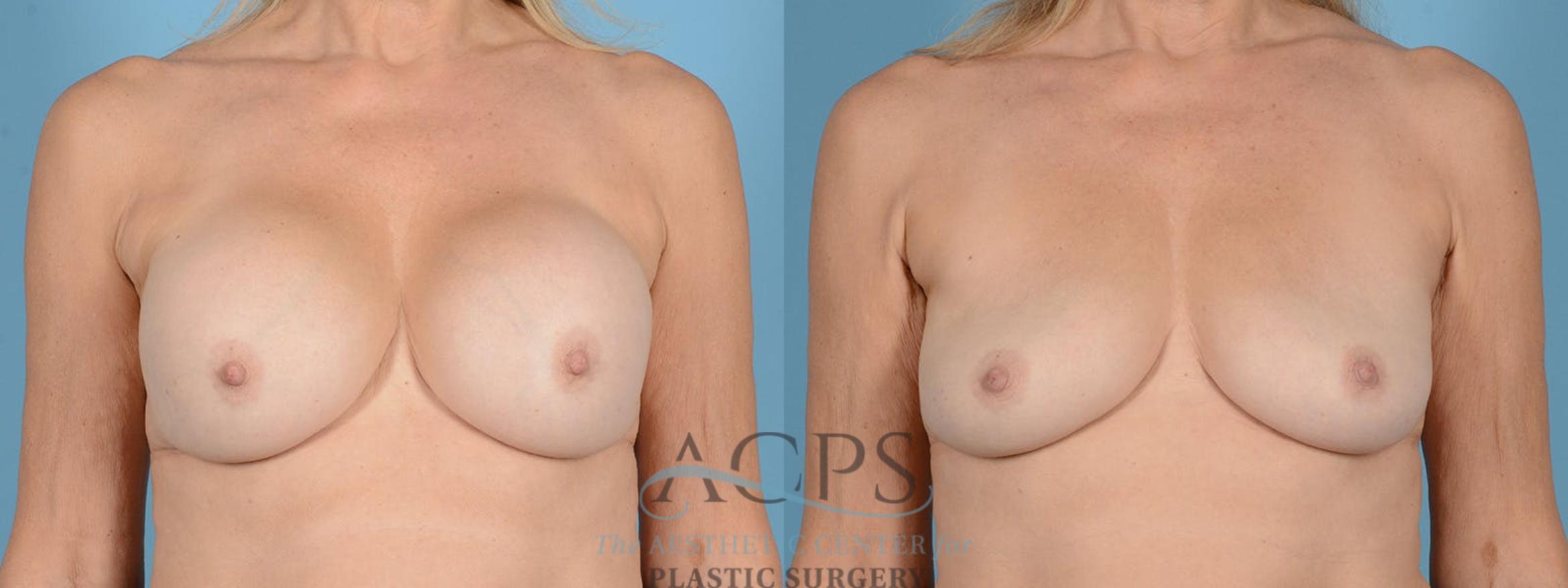 Before & After Breast Revision Case 1053 Front View: View in Houston, TX