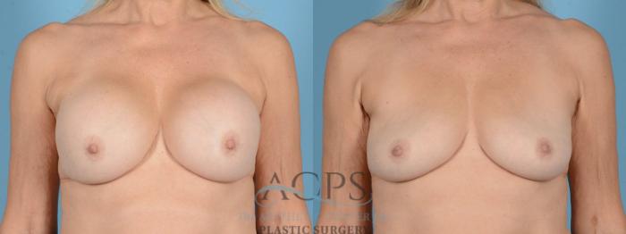 Before & After Breast Revision Case 1053 Front View: View in Houston, TX