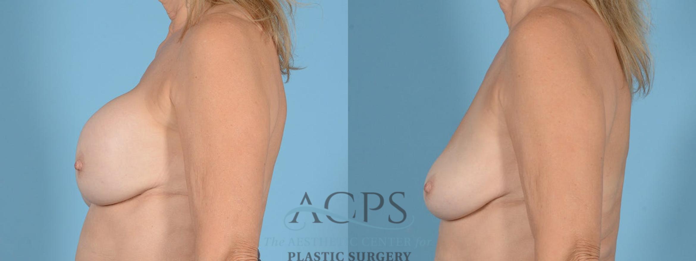 Before & After Breast Revision Case 1053 Left Side View: View in Houston, TX