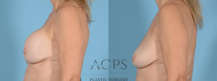 Before & After Breast Revision Case 1053 Left Side View: View in Houston, TX