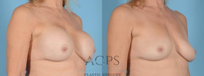 Before & After Breast Revision Case 1053 Oblique View: View in Houston, TX