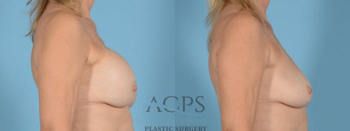 Before & After Breast Revision Case 1053 Side View: View in Houston, TX