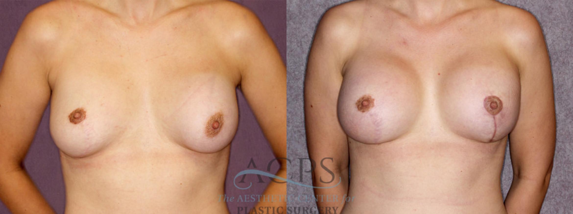 Before & After Breast Revision Case 1054 Front View: View in Houston, TX
