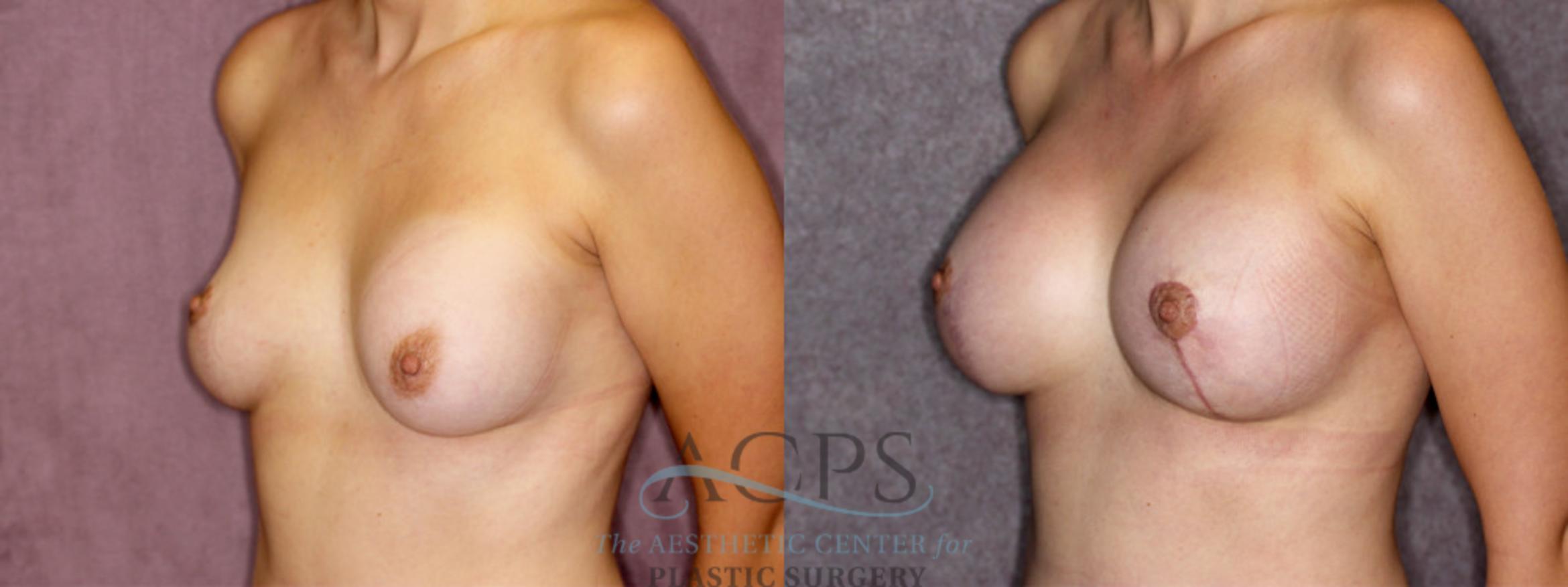 Before & After Breast Revision Case 1054 Oblique Left View: View in Houston, TX