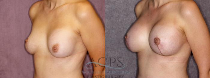 Before & After Breast Revision Case 1054 Oblique Left View: View in Houston, TX