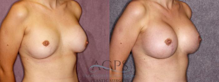 Before & After Breast Revision Case 1054 Oblique Right View: View in Houston, TX