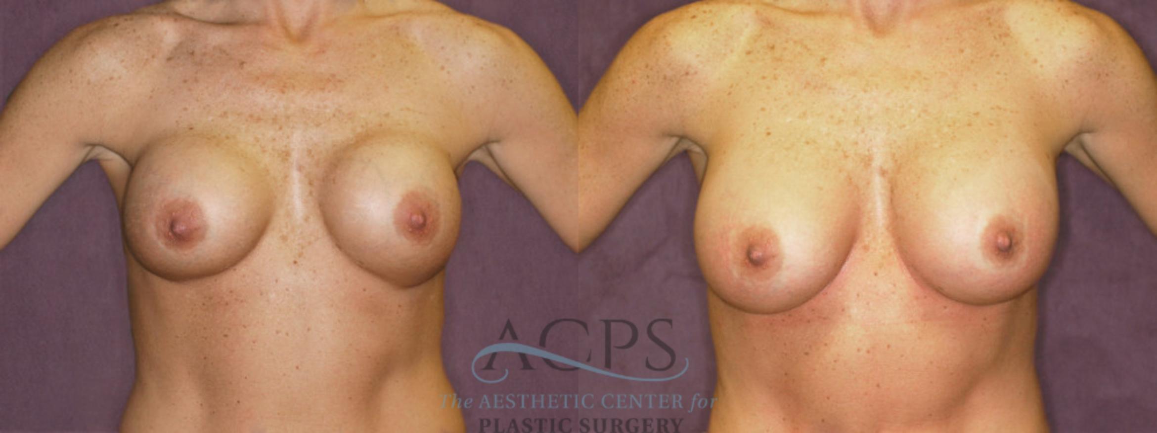 Before & After Breast Revision Case 1055 Front View: View in Houston, TX