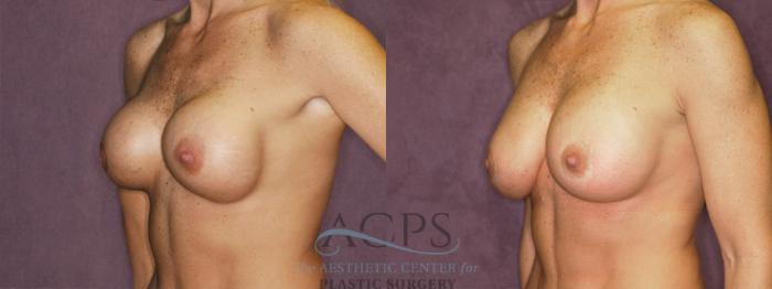 Before & After Breast Revision Case 1055 Oblique Left View: View in Houston, TX