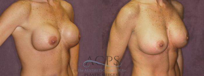 Before & After Breast Revision Case 1055 Oblique Right View: View in Houston, TX