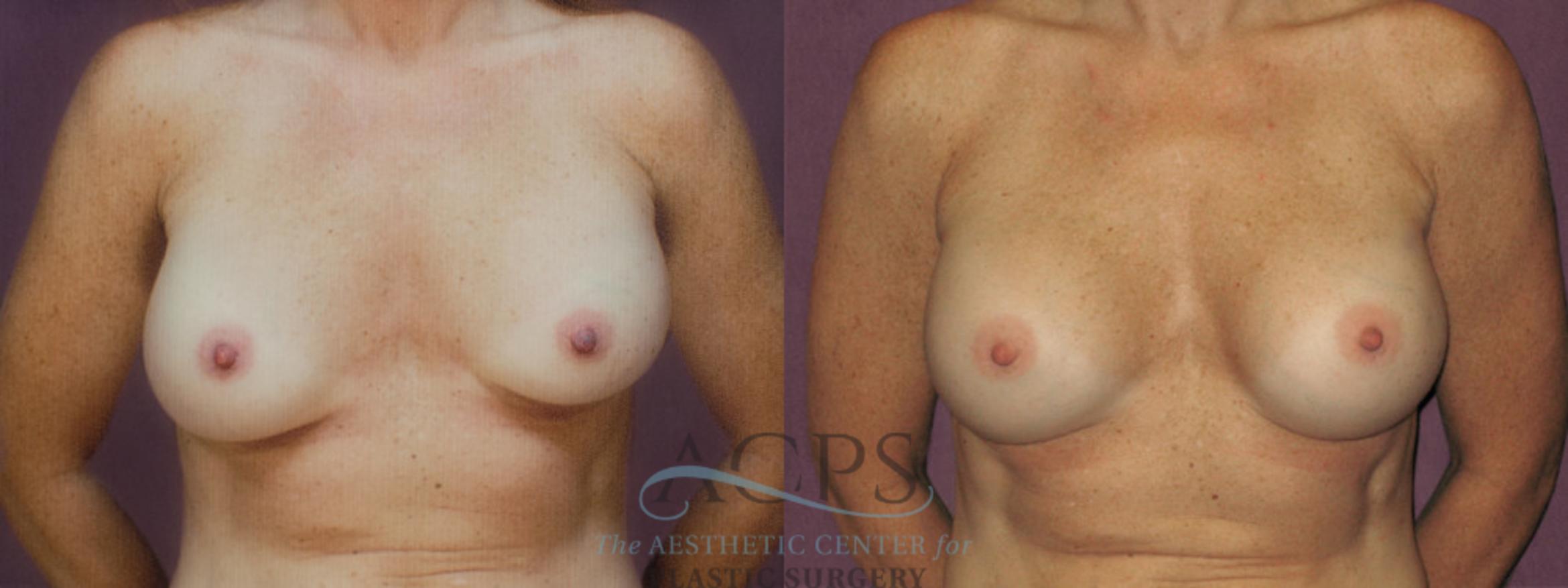 Before & After Breast Revision Case 1058 Front View: View in Houston, TX