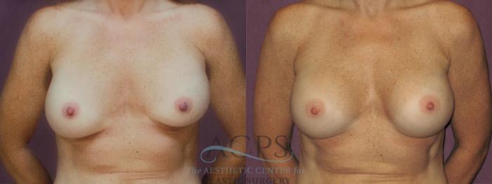 Before & After Breast Revision Case 1058 Front View: View in Houston, TX