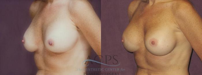 Before & After Breast Revision Case 1058 Oblique Left View: View in Houston, TX