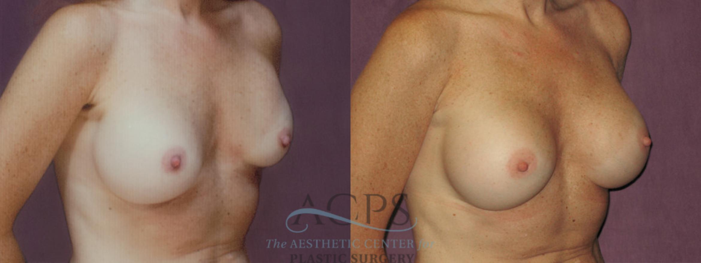 Before & After Breast Revision Case 1058 Oblique Right View: View in Houston, TX