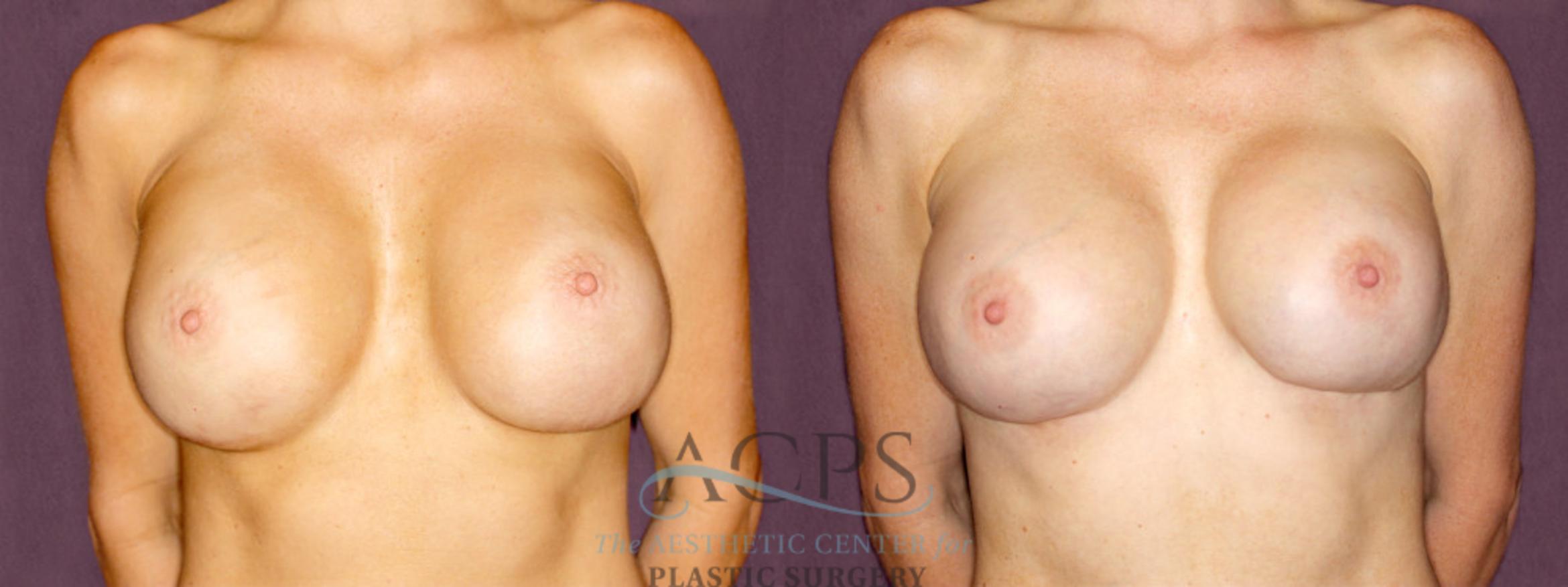 Before & After Breast Revision Case 1059 Front View: View in Houston, TX