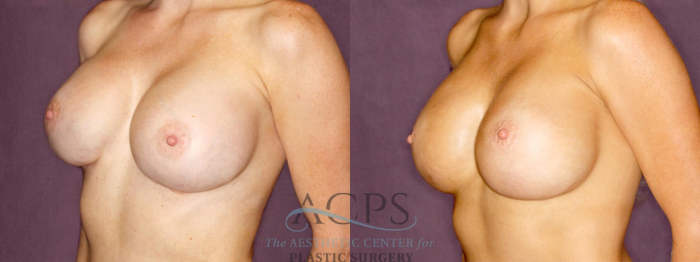 Before & After Breast Revision Case 1059 Oblique Left View: View in Houston, TX
