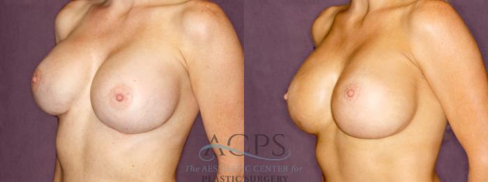 Before & After Breast Revision Case 1059 Oblique Left View: View in Houston, TX