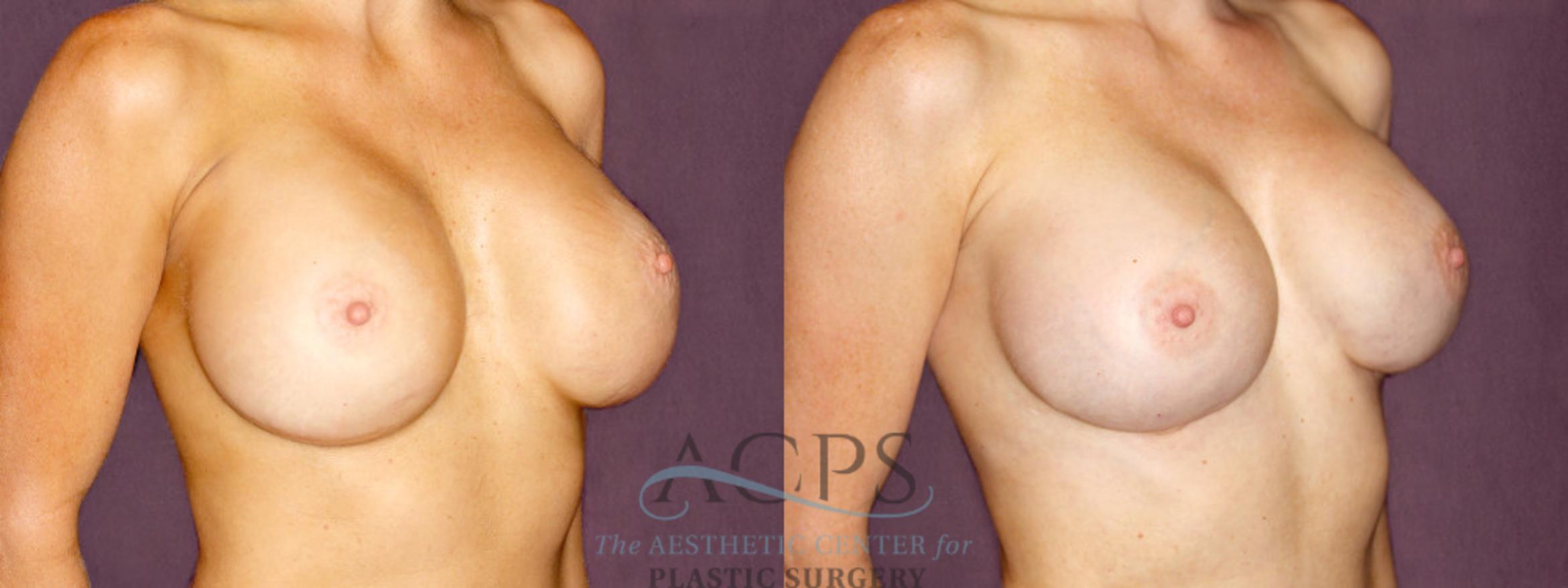Before & After Breast Revision Case 1059 Oblique Right View: View in Houston, TX