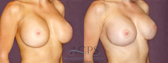 Before & After Breast Revision Case 1059 Oblique Right View: View in Houston, TX