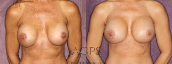 Before & After Breast Revision Case 1060 Front View: View in Houston, TX