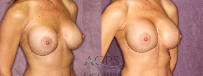 Before & After Breast Revision Case 1060 Oblique Right View: View in Houston, TX