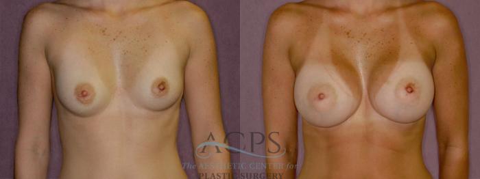 Before & After Breast Revision Case 1061 Front View: View in Houston, TX