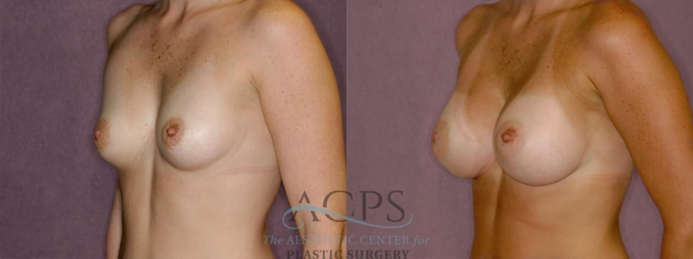 Before & After Breast Revision Case 1061 Oblique Left View: View in Houston, TX