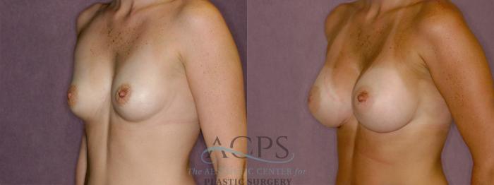 Before & After Breast Revision Case 1061 Oblique Left View: View in Houston, TX