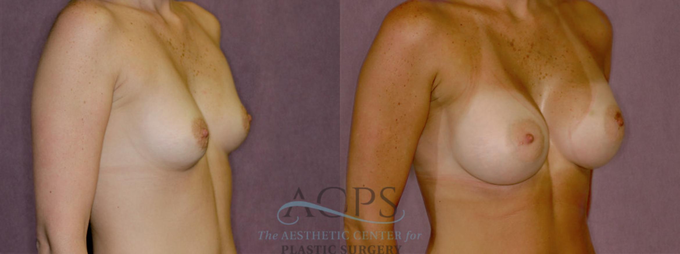 Before & After Breast Revision Case 1061 Oblique Right View: View in Houston, TX