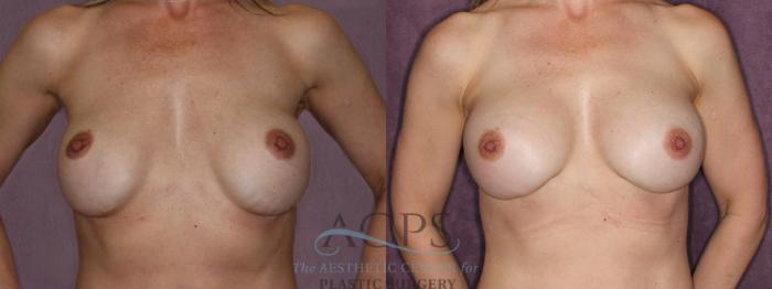 Before & After Breast Revision Case 1062 Front View: View in Houston, TX