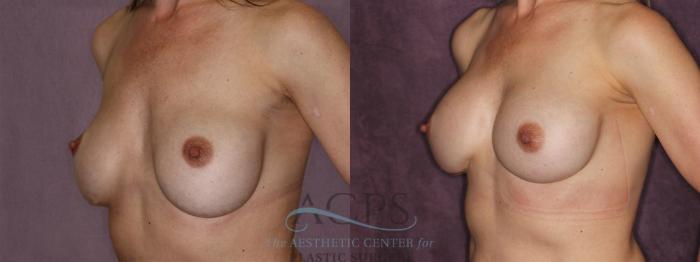 Before & After Breast Revision Case 1062 Oblique Left View: View in Houston, TX