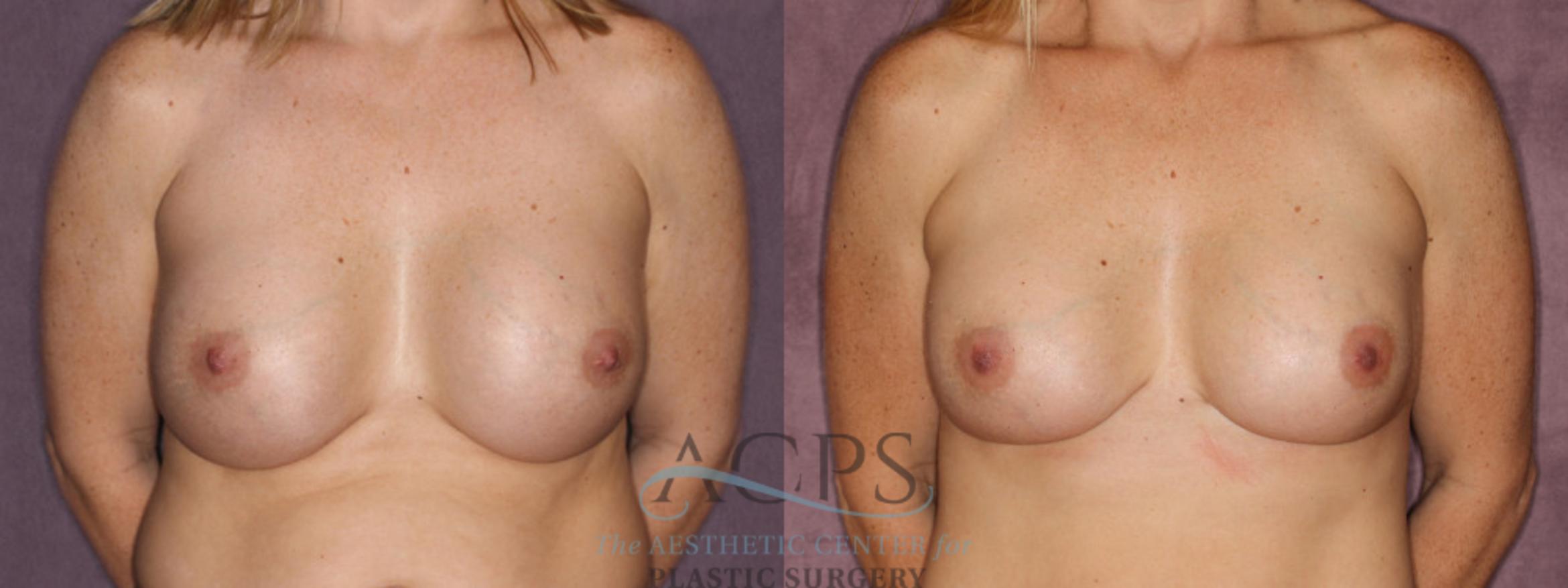 Before & After Breast Revision Case 1063 Front View: View in Houston, TX