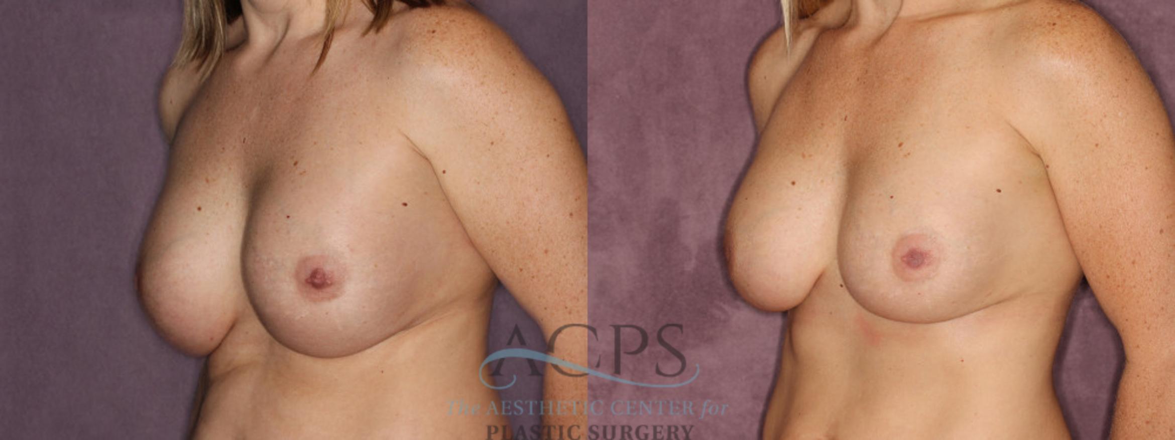 Before & After Breast Revision Case 1063 Oblique Left View: View in Houston, TX