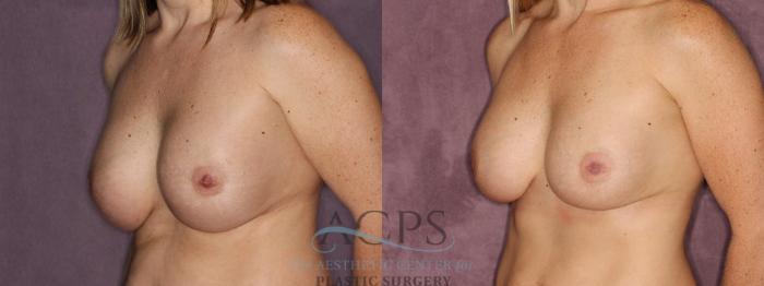 Before & After Breast Revision Case 1063 Oblique Left View: View in Houston, TX