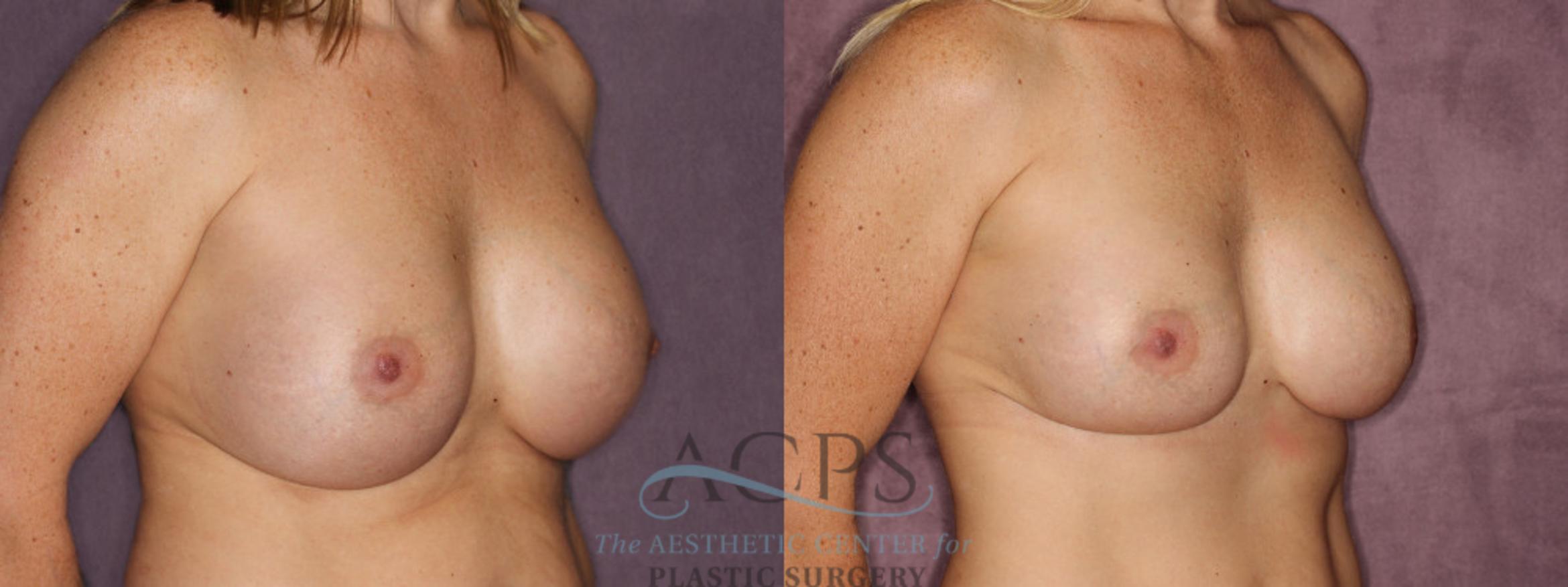 Before & After Breast Revision Case 1063 Oblique Right View: View in Houston, TX
