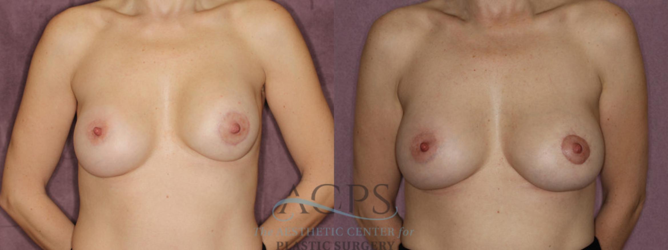 Before & After Breast Revision Case 1064 Front View: View in Houston, TX