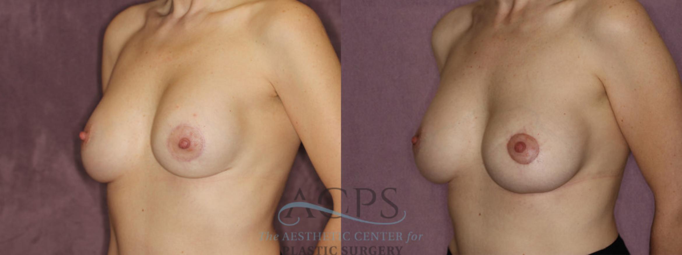 Before & After Breast Revision Case 1064 Oblique Left View: View in Houston, TX
