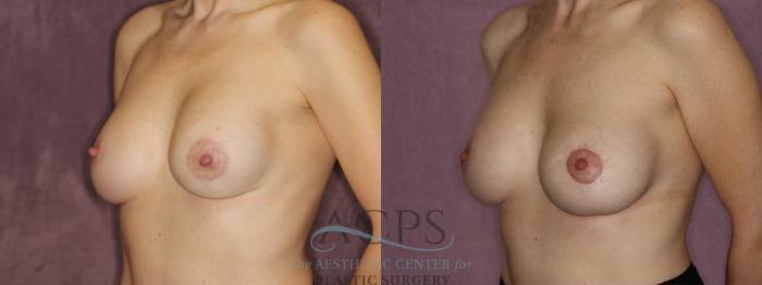 Before & After Breast Revision Case 1064 Oblique Left View: View in Houston, TX