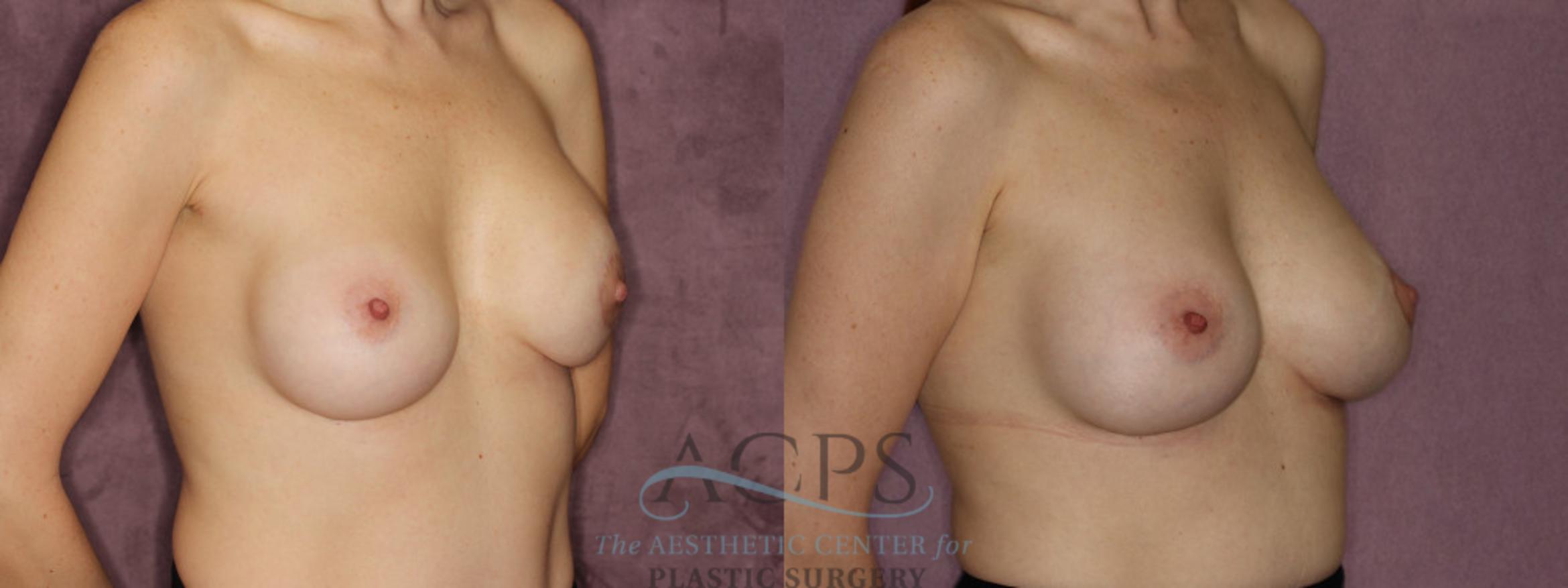 Before & After Breast Revision Case 1064 Oblique Right View: View in Houston, TX