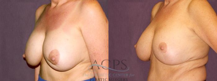 Before & After Breast Revision Case 1065 Oblique Left View: View in Houston, TX