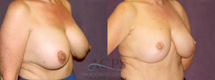 Before & After Breast Revision Case 1065 Oblique Right View: View in Houston, TX