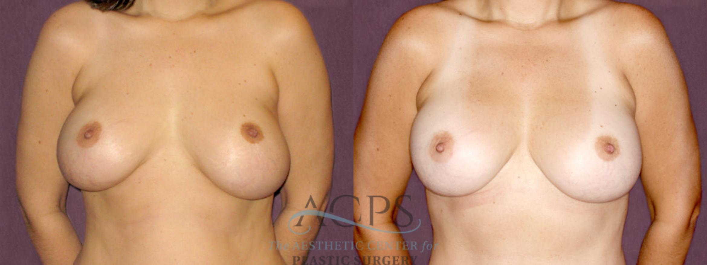 Before & After Breast Revision Case 1066 Front View: View in Houston, TX