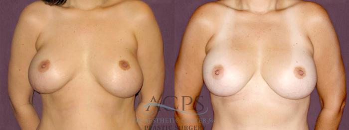 Before & After Breast Revision Case 1066 Front View: View in Houston, TX