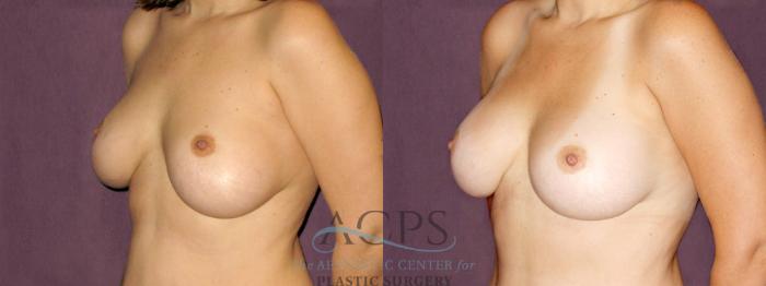 Before & After Breast Revision Case 1066 Oblique Left View: View in Houston, TX