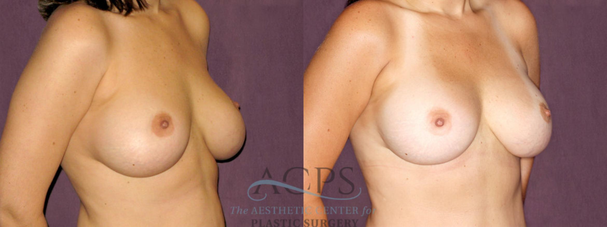 Before & After Breast Revision Case 1066 Oblique Right View: View in Houston, TX