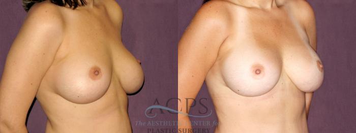 Before & After Breast Revision Case 1066 Oblique Right View: View in Houston, TX