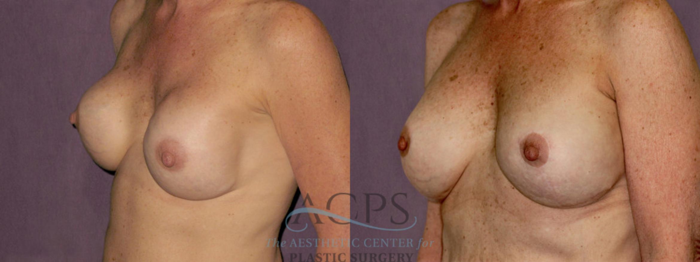Before & After Breast Revision Case 1067 Oblique Left View: View in Houston, TX
