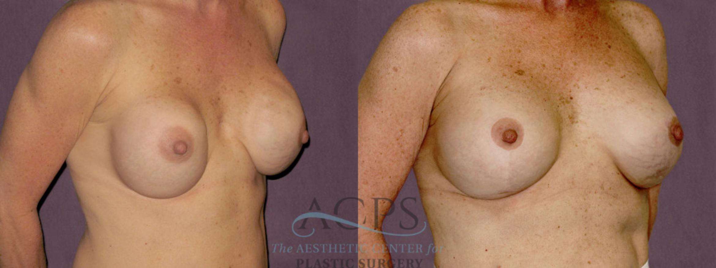 Before & After Breast Revision Case 1067 Oblique Right View: View in Houston, TX