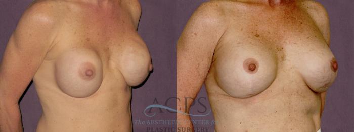 Before & After Breast Revision Case 1067 Oblique Right View: View in Houston, TX